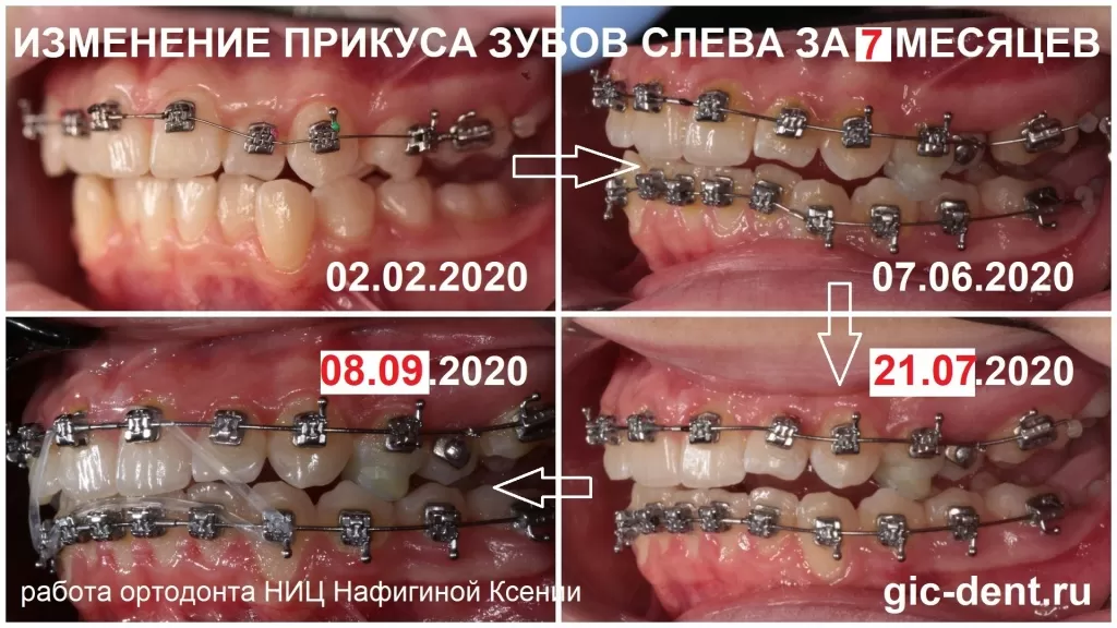 Фотоколлаж зубов слева. Динамика изменения прикуса за 5 месяцев. Исправление прикуса брекетами h4. Лечащий ортодонт- НАфигина Ксения
